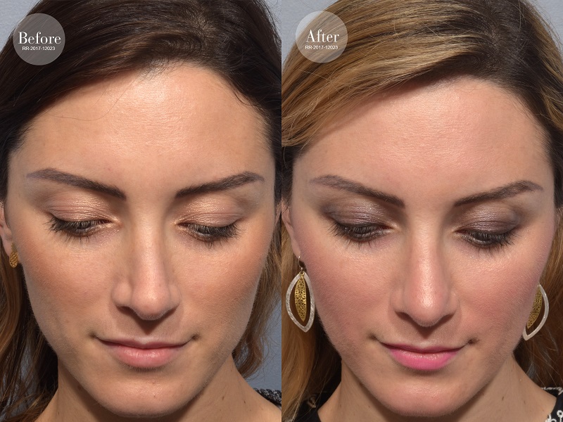 patient before and after revision rhinoplasty