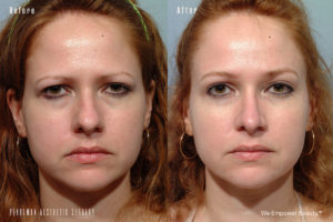 patient before and after eyelid surgery
