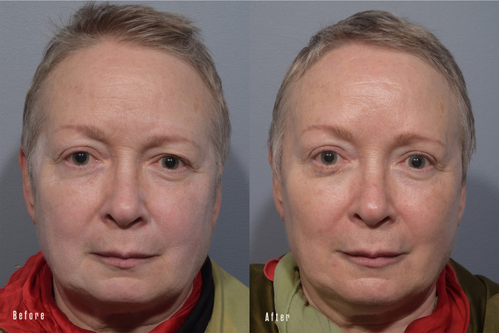 patient before and after eyelid surgery