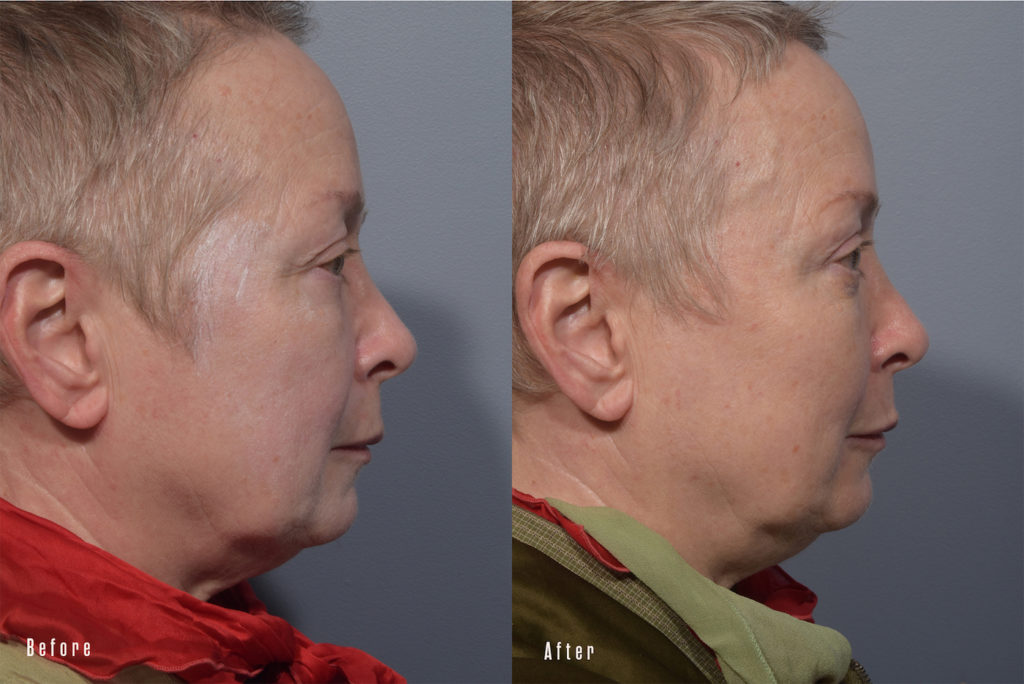 patient before and after eyelid surgery