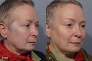 patient before and after eyelid surgery