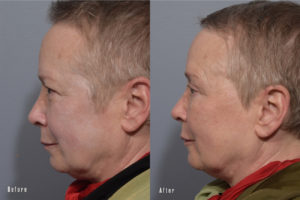 patient before and after eyelid surgery