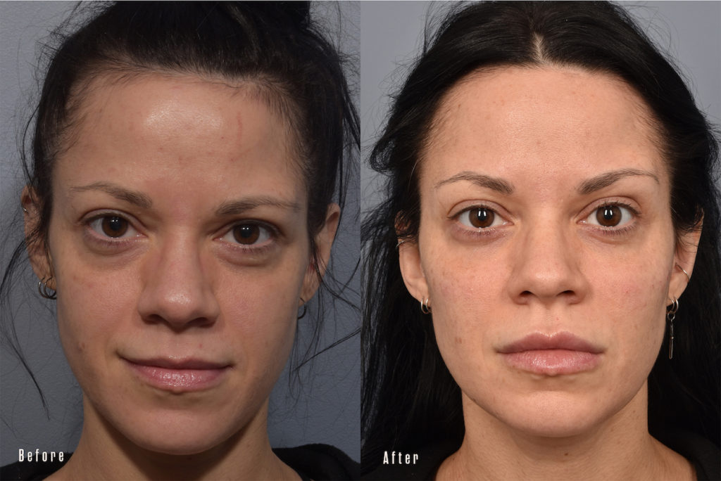 patient before and after eyelid surgery