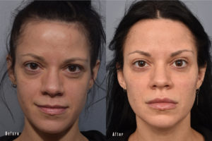 patient before and after eyelid surgery