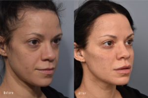 patient before and after eyelid surgery
