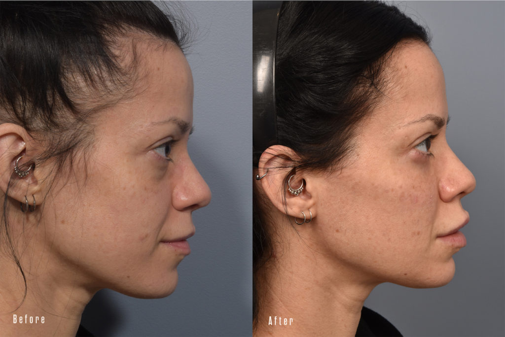 patient before and after eyelid surgery