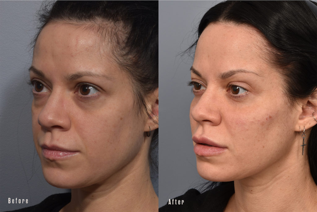 patient before and after eyelid surgery