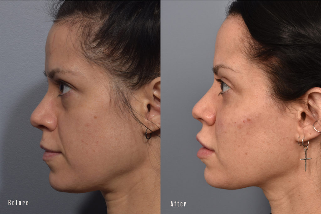 patient before and after eyelid surgery