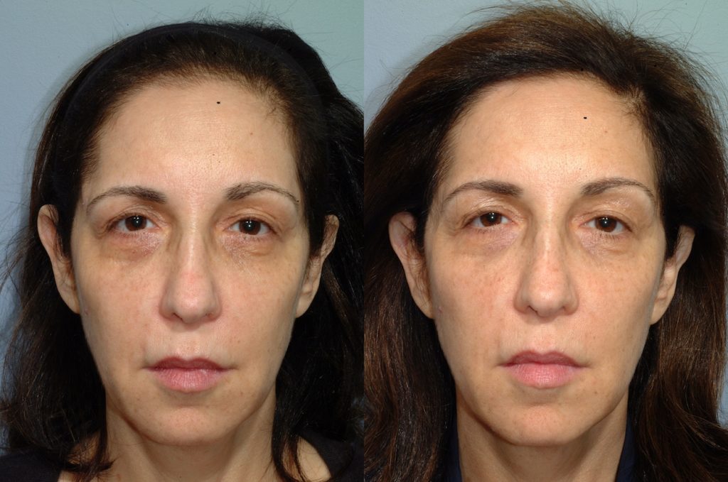 patient before and after FaceTite