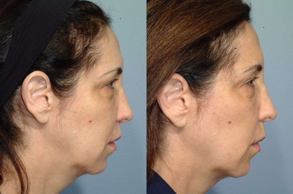 patient before and after FaceTite