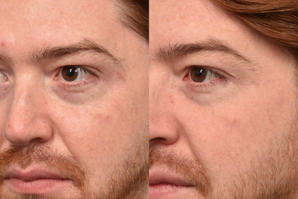 patient before and after Morpheus8