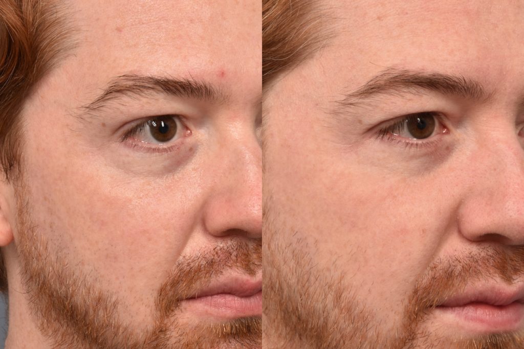 patient before and after Morpheus8