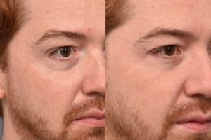 patient before and after Morpheus8