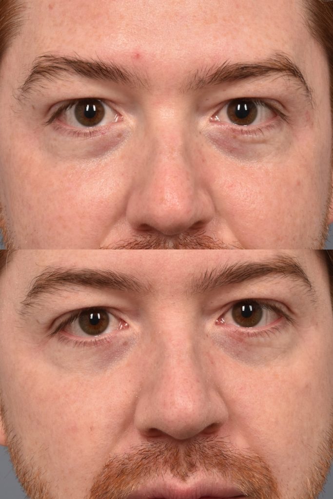 patient before and after Morpheus8