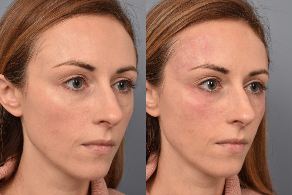 patient before and after Vascular Laser