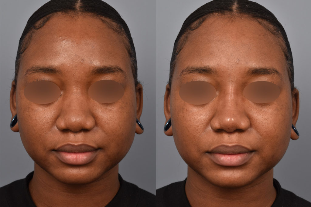patient before and after non surgical rhinoplasty