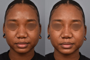 patient before and after non surgical rhinoplasty