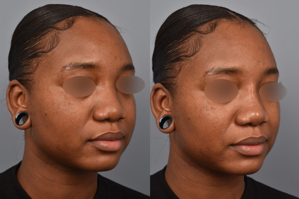 patient before and after non surgical rhinoplasty