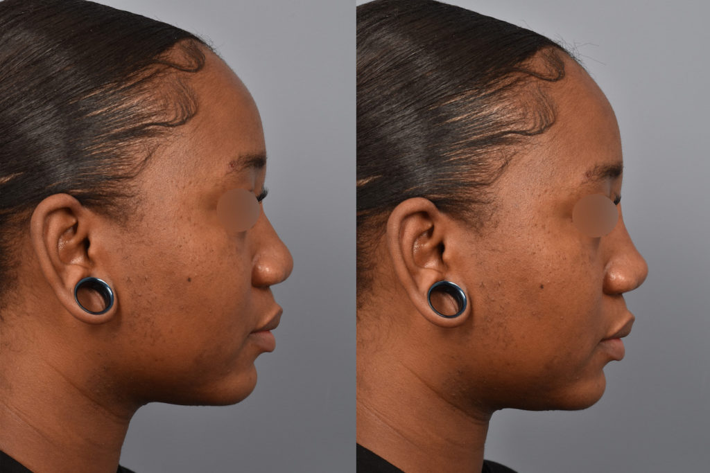 patient before and after non surgical rhinoplasty