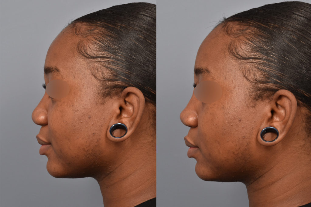 patient before and after non surgical rhinoplasty