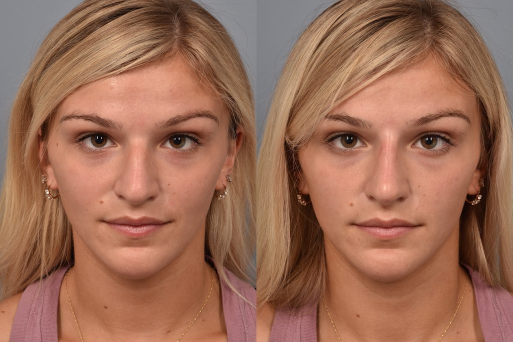 patient before and after non surgical rhinoplasty