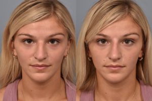 patient before and after non surgical rhinoplasty