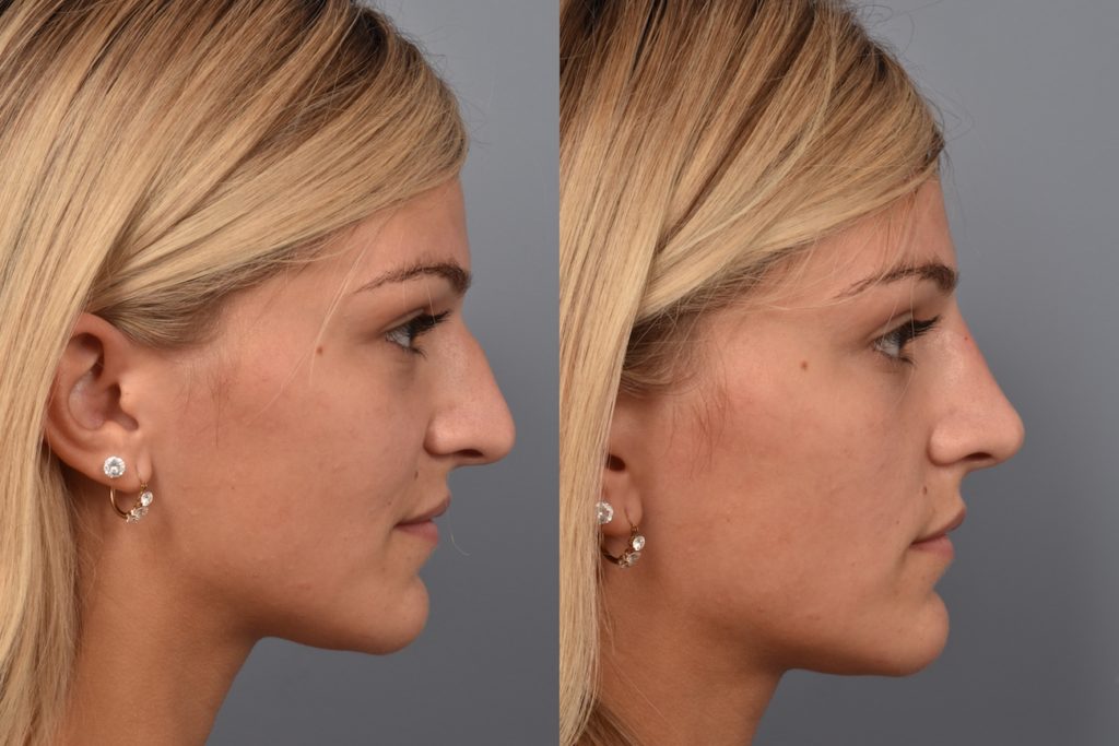 patient before and after non surgical rhinoplasty