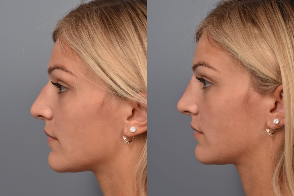 patient before and after non surgical rhinoplasty