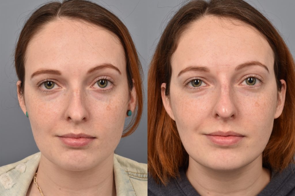 patient before and after non surgical rhinoplasty