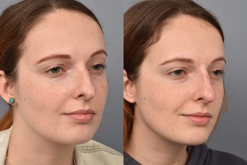 patient before and after non surgical rhinoplasty