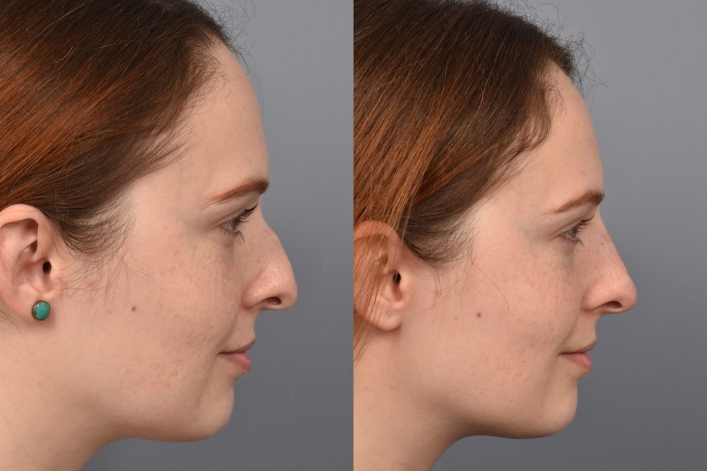 patient before and after non surgical rhinoplasty