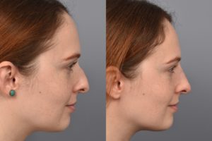 patient before and after non surgical rhinoplasty