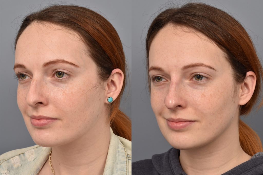patient before and after non surgical rhinoplasty