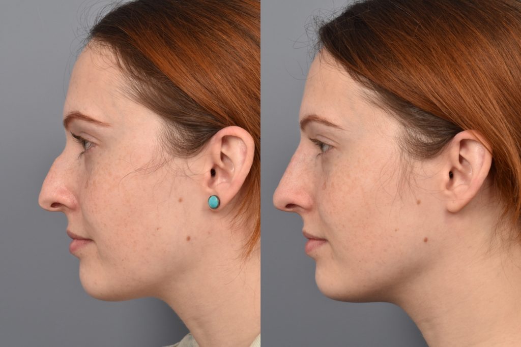 patient before and after non surgical rhinoplasty