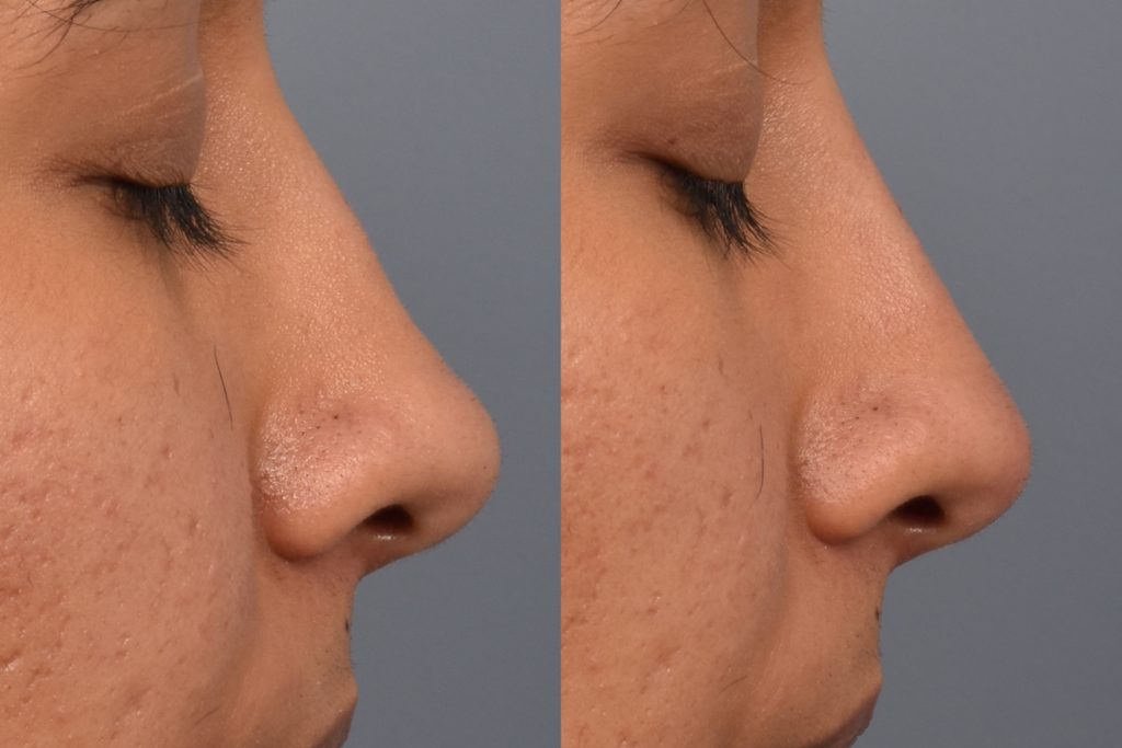patient before and after non surgical rhinoplasty