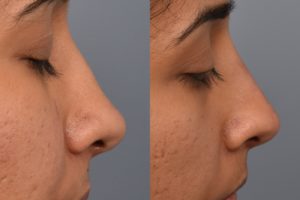 patient before and after non surgical rhinoplasty