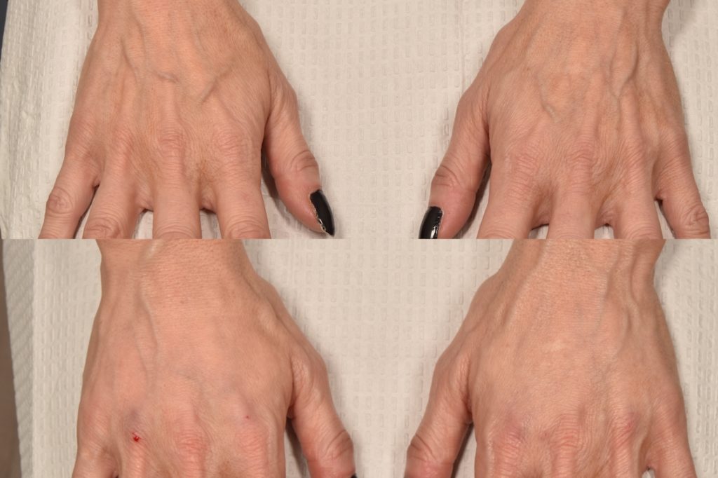 patient before and after hand filler