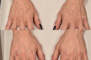 patient before and after hand filler