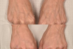 patient before and after hand filler