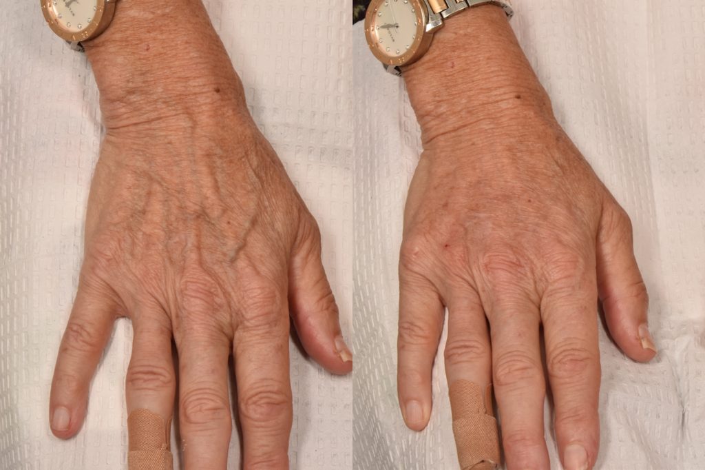 patient before and after hand filler