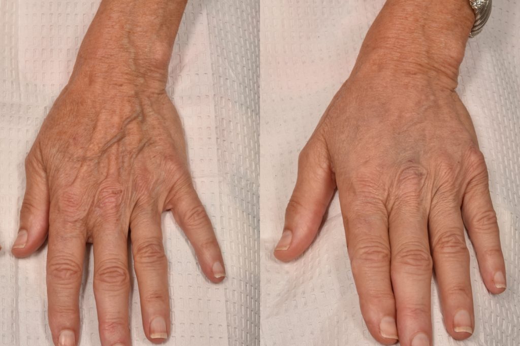 patient before and after hand filler