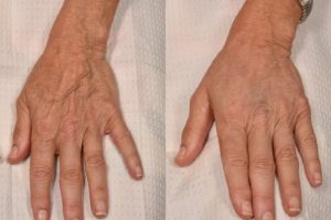 patient before and after hand filler