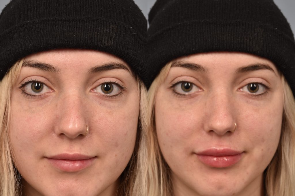 patient before and after lip filler