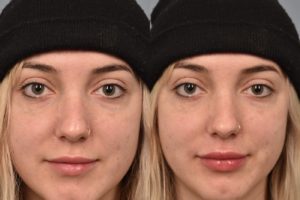 patient before and after lip filler
