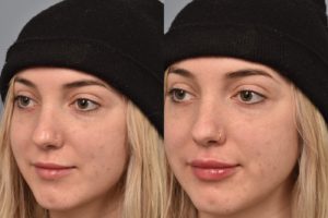 patient before and after lip filler