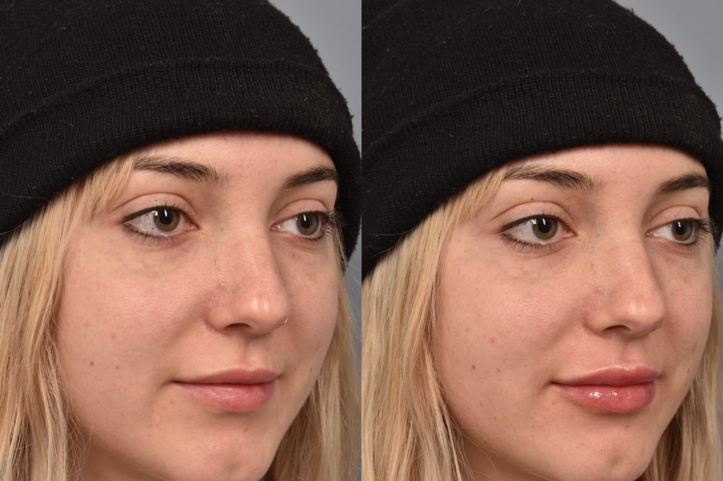 patient before and after lip filler
