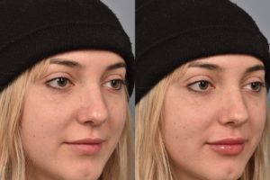 patient before and after lip filler