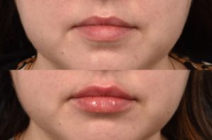 patient before and after lip filler