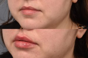 patient before and after lip filler