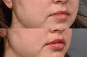 patient before and after lip filler